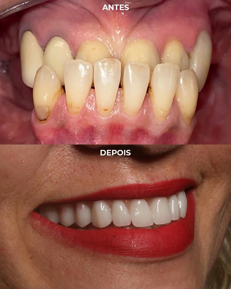 Caso real de antes e depois de implante dentário