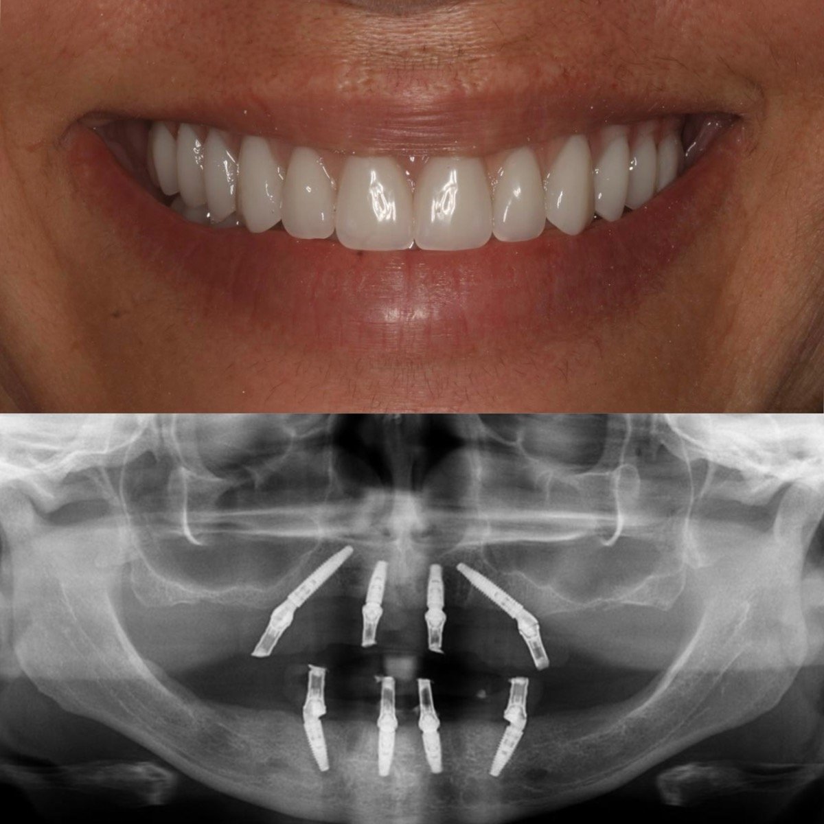 Resultado de reabilitação total com implantes sem enxerto ósseo